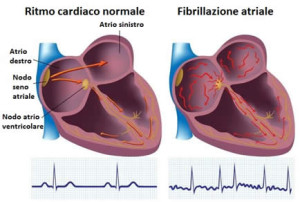 fibrillazione_atriale