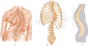 scoliosi