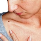 PROGETTO MELANOMA: A Scarperia il 14 maggio “Amici per la pelle”